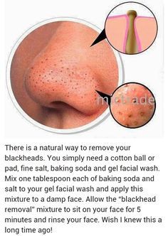 Black Heads, Remove Blackheads, Skin Care Solutions, Body Skin Care Routine, Diy Skin Care, Diy Skin, Healthy Skin Care, Beauty Skin Care Routine