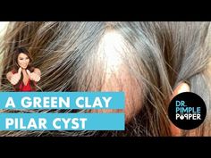 A Green Clay Pilar Cyst - YouTube Green Clay, Click Here, The Creator, Green