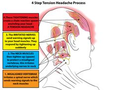 Relief Headache, Punkty Spustowe, Tension Headache Relief, Headache Relief Instant, Throbbing Headache, Headache Types, Essential Oils For Headaches, Trigger Point Therapy, Natural Headache Remedies