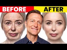 The Ultimate Face Transformation–Dr. Berg's Best Remedy for Dry Skin and Wrinkles - YouTube Remedy For Dry Skin, What Causes Wrinkles, Face Transformation, Dark Spots On Face, Health Disease, Cheap Skin Care Products