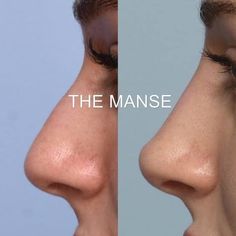 Luxury Clinic, Non Surgical Rhinoplasty, Nose Filler, Face Plastic Surgery, Nose Surgery Rhinoplasty, Nose Fillers, Upturned Nose, Parts Of The Nose, Rhinoplasty Nose Jobs