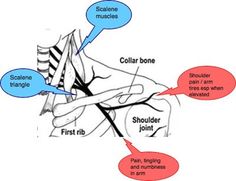 Fitness Stretches, Thoracic Outlet, Rib Pain, Sinus Cavities, Shoulder Rehab, First Rib, Neck Injury, Neck Exercises, Back Pain Exercises