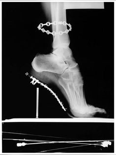 an x - ray shows the foot and ankle in this black and white photo,