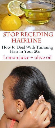 Hairline Remedies, Receding Hairline, Regrow Hair, Hair Starting, Hair Regrowth, Hair Restoration, Strong Hair, Natural Treatments