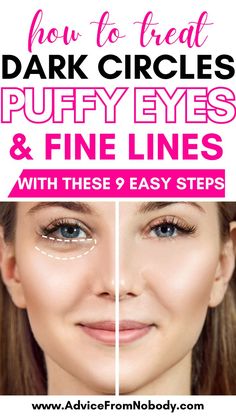 Puffy Eyes Remedies That Work! How to get rid of puffy eyes, dark circles, fine lines, crow's feet, and under-eye bags, the best tips to avoid them, along with DIY remedies, products, and hacks! Whether you have chronic under-eye circles, puffiness due to allergies, or you just need makeup tips for mornings you're extra tired and need to look awake, this post has you covered! Dark circles under eyes| Puffy eye treatment| Eye bags treatment| Eye bag remedies| Puffy bags under eyes. Allergy Eyes, Eyes Dark Circles, Soothing Face Mask, Extra Skin, Under Eye Puffiness