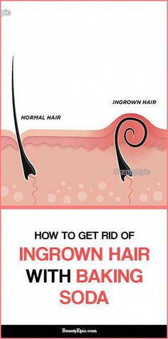 Ingrown Hair, Baking Soda