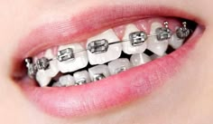 Black Braces Teeth, Orthodontics Marketing, White Braces, Silver Braces, After Braces, Black Braces, Misaligned Teeth, Adult Braces