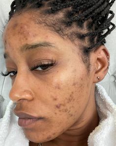 Skin Health begins with Education!HYPERPIGMENTATION is, unfortunately, becoming normal in African, Indian, Pacific Islander,  Native American, Hispanic peopl... Girl With Acne, Pacific Islander, Acne Causes, Best Serum, Simple Skincare