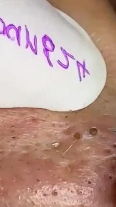 Lip Blackheads, Blackhead Popping, Pimple On Face, Big Zits, Lip Pimple, Pimple Pop, Blackheads Popping Videos Faces, Gallbladder Health, Regular Skin Care Routine