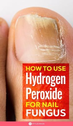 Nail Fungus Remedy, Fungal Nail, Tongue Health, Foot Soak, Toenail Fungus, Fungal Infection, Hydrogen Peroxide, Nail Fungus, Nail Health