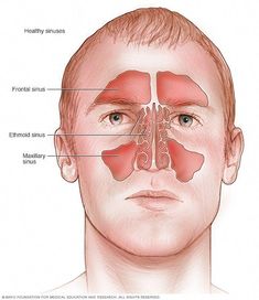 Sinus Massage, Acute Sinusitis, Maxillary Sinus, Sinus Pain, Swollen Eyes, Allergic Rhinitis, Holistic Health Remedies