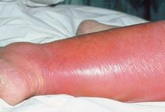 You have a fever and an area of skin that’s red, swollen, and warm. Most likely, you have a case of cellulitis. Learn how to tell for sure and what you should do. Leg Rash, Burn Fat Quick, Celebrity Workout, Bacterial Infection, Medical Help, Skin Diseases, Medical Information, Health And Fitness Tips, Health And Beauty Tips