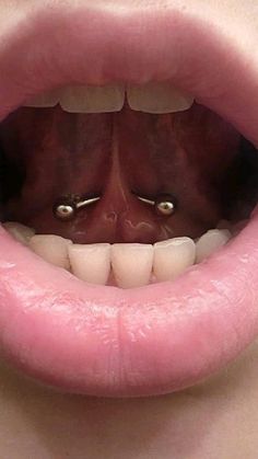 a woman's mouth with two fake teeth