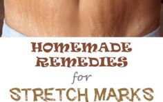 Strech Marks, Stretch Mark Remedies, Skin Remedies, Homemade Remedies, Beauty Recipe, Homemade Beauty Products, Beauty Tutorials, Health And Beauty Tips