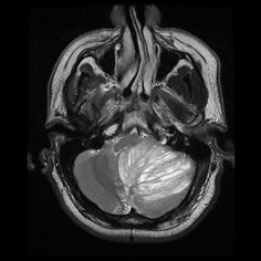 an mri scan shows the location of the cranium in the middle part of the brain