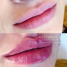 Face Plastic Surgery, Dermal Fillers Lips, Lips Fillers, Lips Shape, Permanent Lipstick, Kiss Lips