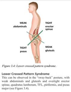 Glutes Anatomy, Swayback Posture, Stenosis Exercises, Quadratus Lumborum, Lumbar Lordosis, Anterior Pelvic Tilt, Glute Muscles, Yoga Teacher Resources, Massage Therapy Techniques