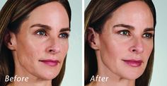 https://flic.kr/p/DHwUAN | Volbella Lip Filler | Volbella Facial Filler Dr. John L. Burns, Jr., MD Board Certified Plastic Surgeon President, Dallas Plastic Surgery Institute Lip Injections