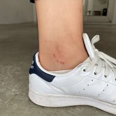 a close up of a person's foot with small black dots on it