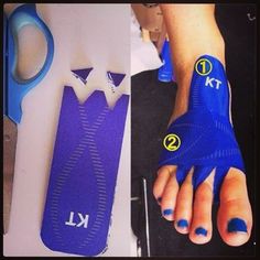 KT Tape app for metatarsal stress fracture. (Similar technique to the app for Morton's Neuroma) Kt Tape, Kinesio Taping, Running Injuries, Gut Healing, Athletic Training, Track Workout