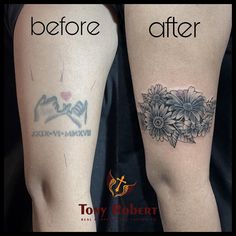 before and after tattoo removals on the legs