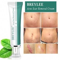 Scare Removal Cream, Acne Scar Removal Cream, Scar Removal Cream, Scar Remover, Acne Scar, Cream Face, Acne Scar Removal, Healthy Skin Tips