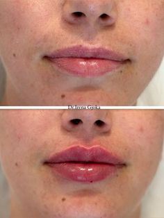 Lips injection used 0.5ml 💉         #lips #lipsticklove #lipsremedy #lipfillersbeforeandafter #lipfillersbeforeandafter #lipfillersstyles #lipfiller #lips #fillers #aesthetic #injection #doctorlife #medicine #natural #natura 0 5 Ml Lip Filler, Lip Filler 0.5ml, 0.5ml Lip Filler Before And After, Lip Filler Natural, Aesthetic Injections, Russian Lips Filler, Lips Injection, Fillers Aesthetic