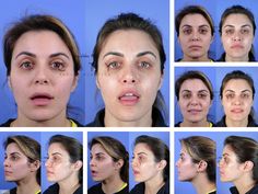 Lip Lift Before and After | New York Plastic Surgeon Dr. Linkov Lip Surgery Before And After, Kpop Plastic Surgery, Jaw Reduction Surgery, V Line Surgery, Lady Lounge