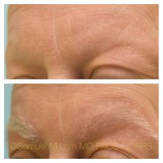 This 59-year-old gentleman who suffered in the past from trichotillomania is shown before and four months after eyebrow hair transplant with a good aesthetic outcome. Eyebrow Hair Transplant, Hair Restoration, Hair Transplant, Gentleman, Eyebrows, Hair Hair, The Past, Hair