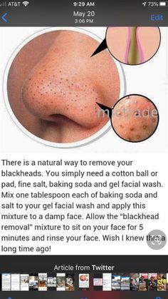 Blackhead Remedies, Black Heads, Makeup Tip, Tan Removal, Remove Blackheads, Natural Sleep Remedies, Natural Cold Remedies, Get Rid Of Blackheads, Natural Cough Remedies