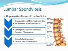 Lumbar Spondylosis And Physiotherapy Treatment Pars Defect, Spondylosis Lumbar, Physiotherapy Knowledge, Lumbar Strain, Lumbar Spondylosis, Skeleton Muscles, Chiropractic Quotes, Lumbar Disc, Referred Pain