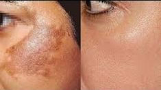 Tired of hyper pigmentation and spots on the face ? here is guaranteed natural remedy – TRY this Age Spots On Face, دورة شهرية, Acne Remedies, Skin Remedies, Prevent Wrinkles, Skin Tips, Anti Aging Skin Products, New Skin