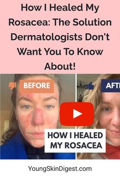 How I Healed My Rosacea: The Solution Dermatologists Don't Want You To Know About! Red Face Remedies, Redness Remedy, Moroccan Lentil, Proactive Skin Care, Saving Face, I Healed, Ben Johnson, Facial Skincare, Acne Treatments