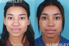 African American Rhinoplasty, Nose Operation Before After, Rhinoplasty Results, Turkish Rhinoplasty, Rynoplasty Surgery, Nose Surgery Before And After, Alarplasty Before After, Nose Tip Surgery Before After, Ethnic Rhinoplasty African Americans