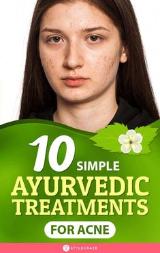 Antioxidant, anti-inflammatory, and healing properties of ayurvedic remedies help treat acne gently. Try these DIY ayurvedic tips for acne-free clear skin. Homemade Acne Mask, Natural Remedies For Acne, Treatments For Acne, Ayurvedic Tips, Remedies For Acne, Oily Skin Face, Acne Diet, Ayurveda Lifestyle