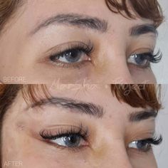 Cat Eye Surgery, Fox Eye Surgery Before And After, Fox Eye Lift Before And After, Foxy Eyes, Botox Cosmetic