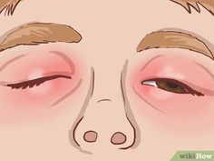 How to Treat Eczema Around the Eyes (with Pictures) - wikiHow Eyelid Excema, Staphylococci Bacteria Remedies, Itchy Eyelids, Lichen Planus, Skin Remedies, Allergic Reaction, Acne Skin, Vegan Food