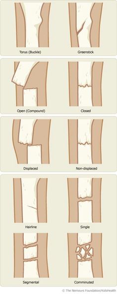 Types of fractures Types Of Fractures, Muzică Rock, Studera Motivation, Bone Fracture, Nursing School Studying, Nursing School Tips, Medical School Studying, Nursing School Notes, Medical Terminology