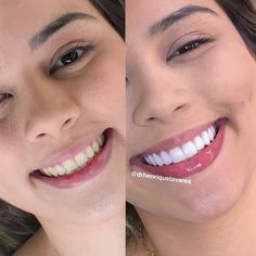 WhatsApp 062-984911991 . Profissional responsável C.D. Dr Henrique Ferreira Tavares CRO-Go 9152 . Primeira foto diagnóstico inicial .… White Teeth Aesthetic, Windows To The Soul, Facial Contouring, Whiten Your Teeth