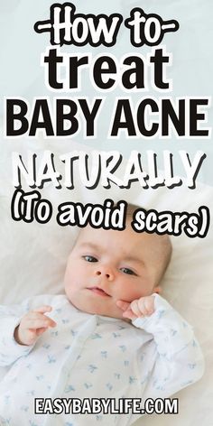 DESPERATE to get rid of your baby's acne? Here are the causes baby acne and how to treat it! Newborn babies up to a few months old often get this, and as a new mom, it is key to know helps. Neonatal acne is a baby skin rash that isn't very pretty, but it does resolve!

Also good for baby care tips, baby health, parenting advice, breast milk, breastfeeding tips, baby life hacks, 1 month old, 2 months old, baby development Newborn Skin Peeling, Baby Life Hacks, Baby Care Tips, Skin To Skin, Newborn Babies