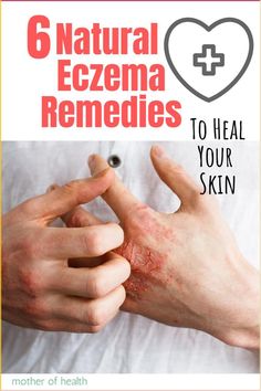 You may have tried many “cures” for eczema without much success. Maybe you want a more natural and holistic way of healing your skin and your body? I don’t blame you. Natural eczema remedies are plentiful and address the root cause for your chronic skin condition, unlike the proposed medical solutions. Learn more here.  #eczema #eczemaremedies #eczematreatment #naturalremediesforeczema #howtogetridofeczema #howtotreateczema #eczemarelief #eczematreatmentremedies #facialeczema Home Remedies For Warts, Warts Remedy, Asthma Remedies, Rogue Fitness, Skin Disorders, Chiropractic Care, Skin Remedies, Manuka Honey, Yoga Sequences