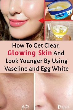 How to get clear, glowing skin and look younger by using Vaseline and egg white Obličejové Masky, Winter Skincare, Skin Face Mask, Natural Beauty Remedies, Clear Glowing Skin, Natural Glowing Skin, Spots On Face, Healthy Skin Tips