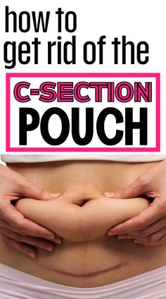 A new mom showing her postpartum c-section pouch belly and how to get rid of it fast! C Section Belly Get Rid Of, C Section Pouch, C Section Belly, Postpartum Wrap, Post C Section, Belly Pouch, C Section Workout, Post Partum Belly Wrap, C Section Scars