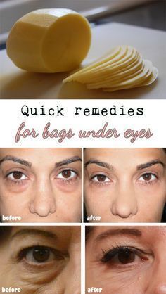 natural and quick remedies for bags | Diy For Bags Under Eyes, Removing Bags Under Eyes, Under Eye Bags, Black Bags Under Eyes, How To Get Rid Of Bags Under Eyes, Make Up, Beauty Tips, Hair Beauty, Beauty Secrets Puffy Eyes Remedy, Under Eyes, Under Eye Bags, Beauty Remedies, Homemade Remedies, Puffy Eyes, Eye Bags, Homemade Beauty Products, Health And Beauty Tips