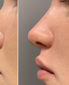 Nose Job Natural, Nose Job Inspiration Natural, Perfect Nose Front View, Nose Job Inspo, Natural Nose Job, Ideal Nose, Nose Aesthetic