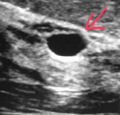 #Breast #ultrasound shows a #simple, #clear #benign #cyst which are very #common in #women. #radiologist #radiology #breastcancer #cancer Quick Saves