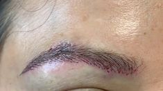 Dallas Ethnic Half Asian Overplucked Partial Eyebrow Transplant Immediat... Eyebrow Implants, Overplucked Eyebrows, Eyebrow Transplant, Beauty