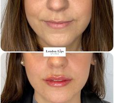 Thin lip filler technique - Google Search Lip Filler Technique, Lip Filler, Lip Fillers, Lips, Google Search