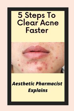 A Pharmacist's Advice On Health Beauty and Wellness Aesthetic Pharmacist, Acne Advice, Acne Types, Clear Acne Fast, Acne Reasons, Acne Scar Remedies, Aesthetic Treatments, Scar Remedies, Acne Medication