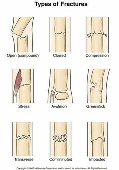 the different types of fractured bones and their corresponding structures are shown in this diagram, which shows